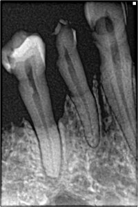 Periodontit