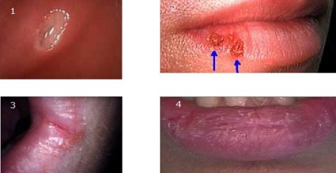 Ağız Yaraları (Aft, Herpes)