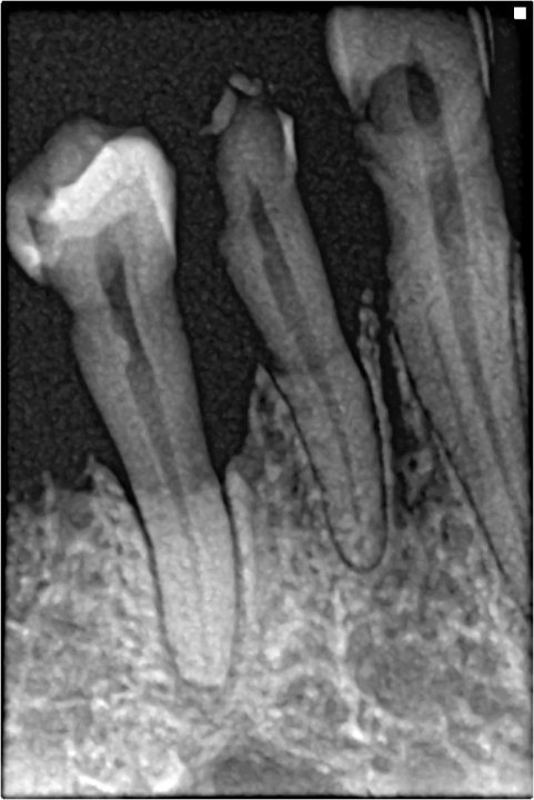 Periodontit